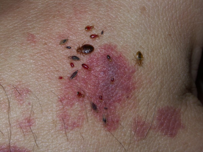 噛み 跡 ノミ ダニに刺された跡の特徴(症状)は二ヶ所赤い腫れ？一カ所の場合は？